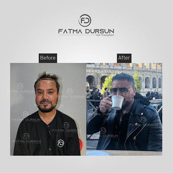 fatmadursun-before-after-1-2 (1)