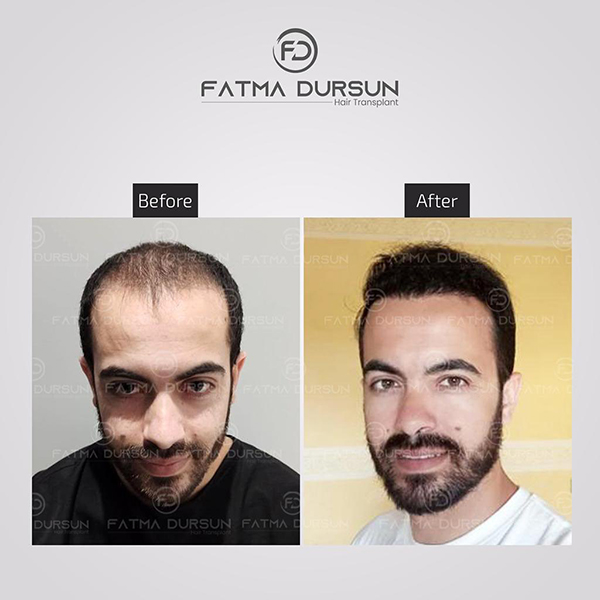 fatmadursun-before-after-1-2 (2)