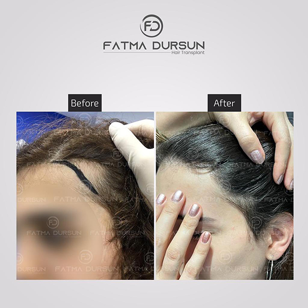 fatmadursun-before-after-1-2 (3)