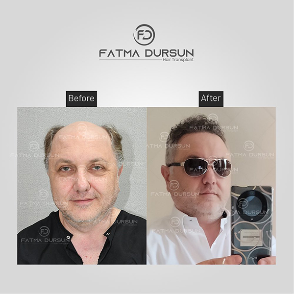 fatmadursun-before-after-1-2 (4)